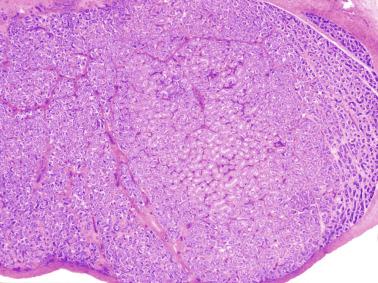 Fig. 12.53, Contralateral scrotal testis from a cryptorchid patient showing a group of large seminiferous tubules that stands out from the surrounding small tubules.