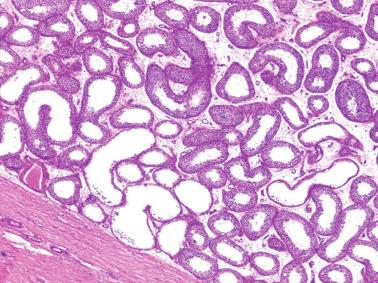 Fig. 12.54, Martin-bell syndrome (fragile X chromosome).