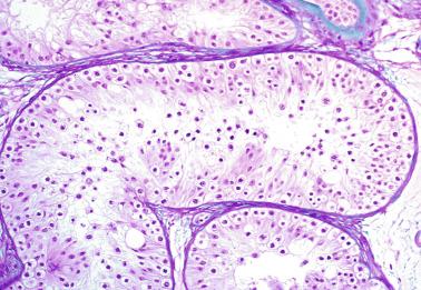 Fig. 12.55, Martin-bell syndrome (fragile X chromosome).