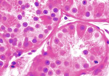 Fig. 12.56, Martin-bell syndrome (fragile X chromosome).