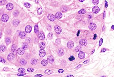 Fig. 12.57, Macroorchidism in a 3-year-old infant with hypothyroidism. The Sertoli cells have spherical nuclei that contain small heterochromatin granules. Two mitotic figures are seen. The testicular interstitium has no Leydig cells.