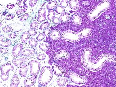 Fig. 12.60, Maturation of the seminiferous tubules located at the periphery of a Leydig cell tumor.