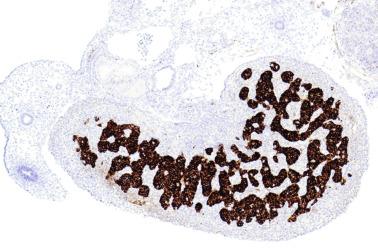 Fig. 12.6, An 8-week-old fetal testis showing intense expression of inhibin in pre–Sertoli cells that form sex cords.