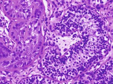 Fig. 12.61, Seminiferous tubule with abundant spermatogonia and first-order spermatocytes in a 3-year-old child at the periphery of a hyalinizing intratubular Sertoli cell neoplasia.