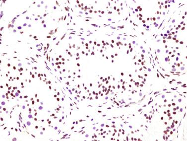 Fig. 12.63, Sertoli cell hyperplasia (same patient as in Fig. 12.62 ).