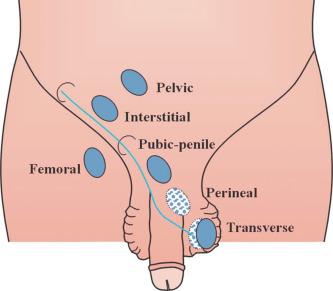 Fig. 12.64, Different locations of ectopic testis.