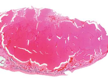 Fig. 12.67, Cystic dysplasia of the rete testis in a newborn.