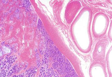 Fig. 12.68, Marked luminal dilation of the ductus epididymidis in an infant with cystic dysplasia of the rete testis.