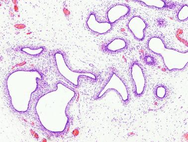 Fig. 12.69, Cystic dysplasia of the epididymis.