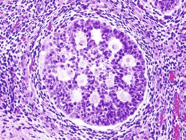 Fig. 12.71, Fetal gonadoblastoid testicular dysplasia.