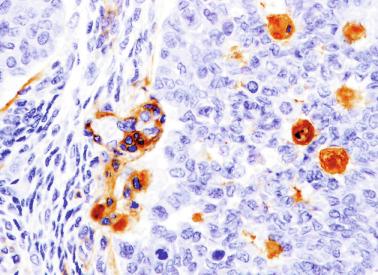 Fig. 12.72, Fetal gonadoblastoid testicular dysplasia.