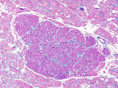 Fig. 12.73, Sertoli cell nodule.