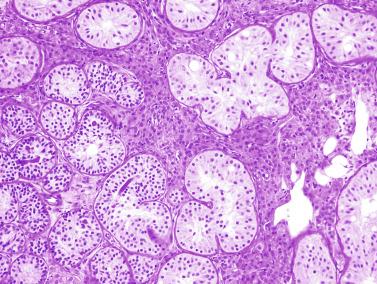 Fig. 12.74, Sertoli cell nodule.