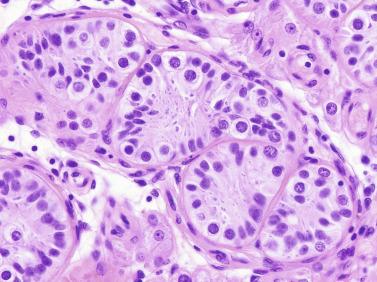 Fig. 12.75, Sertoli cell nodule.