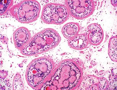 Fig. 12.76, Sertoli cell nodule.