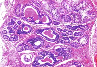 Fig. 12.77, Sertoli cell nodule.