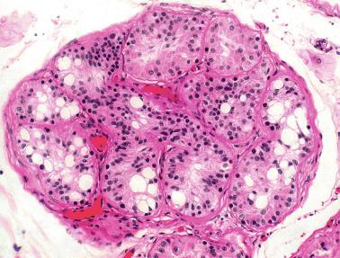 Fig. 12.78, Sertoli cell nodule.