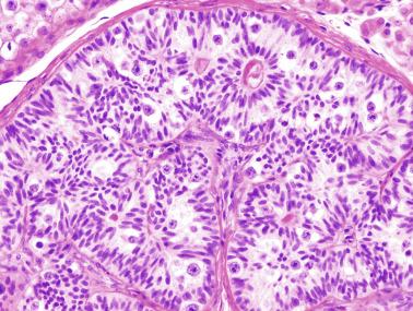 Fig. 12.79, Sertoli cell nodule showing atypical gonocytes among prepubertal Sertoli cells in an adult patient with germ cell tumor.