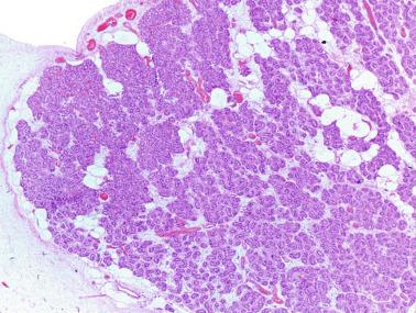 Fig. 12.80, Congenital testicular lymphangiectasis.