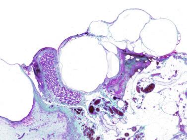 Fig. 12.81, Epididymal lymphangiectasis.