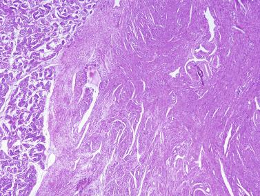 Fig. 12.82, Smooth muscle hamartoma in the lower pole of the testicle. The lesion is in continuity with the albuginea.