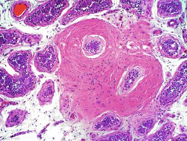 Fig. 12.83, Peritubular hamartoma.