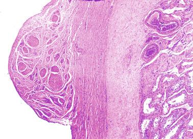 Fig. 12.84, Smooth muscle hamartoma within enlarged tunica albuginea.