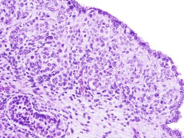 Fig. 12.86, The blastema is located between the lining epithelium of the testis and the seminiferous tubules occupying an expansion of the albuginea. The major population consists of small nucleus cells (pre-Sertoli), among which there are larger ones (gonocytes).