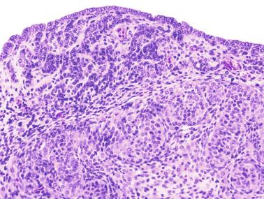 Fig. 12.87, Testis from 2-month-old infant showing ectopic seminiferous tubules within the tunica albuginea in the upper testicular pole.