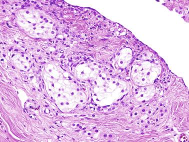 Fig. 12.89, Cluster of ectopic seminiferous tubules and Leydig cells in the wall of a hernia sac in an adult as an incidental finding.