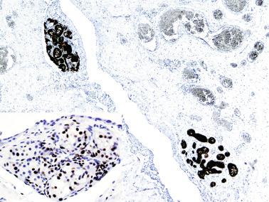 Fig. 12.90, Ectopic seminiferous tubules in the wall of a hernia sac.