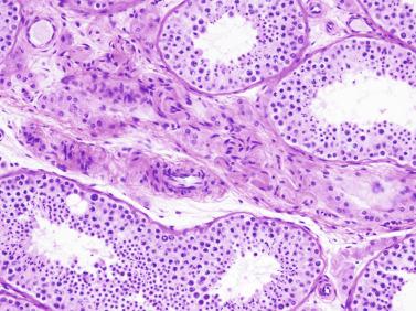 Fig. 12.92, Ectopic Leydig cells in an interlobular septum associated with nerve fibers.