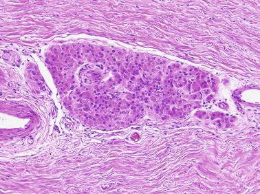 Fig. 12.93, Ectopic Leydig cells around a nerve in albuginea.