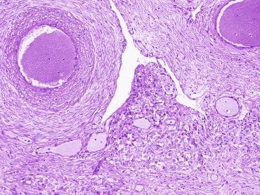 Fig. 12.94, Ectopic Leydig cells in the tunica vasculosa protruding inside a lymphatic vessel.