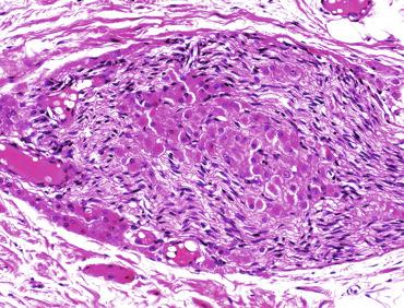 Fig. 12.96, Ectopic Leydig cells inside and around a spermatic cord nerve. Ectopic Leydig cells are distinguished from neuronal ganglion cells by their smaller size.