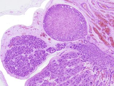 Fig. 12.97, Ectopia of adrenal cortex in the epididymis in a newborn. The adrenal cortex nodule is the same size as the caput of the epididymis.