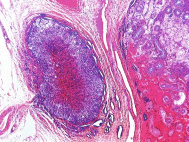 Fig. 12.98, Cortical adrenal ectopia surrounded by extratesticular rete testis cavities in a cryptorchid testis with immature and hyalinized tubules.