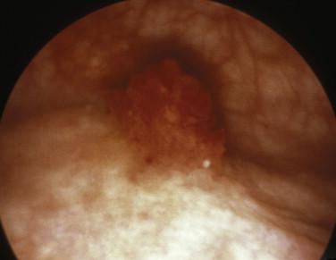 FIGURE 3-14, Nephrogenic adenoma: cystoscopic findings. A papillary lesion simulating cancer.