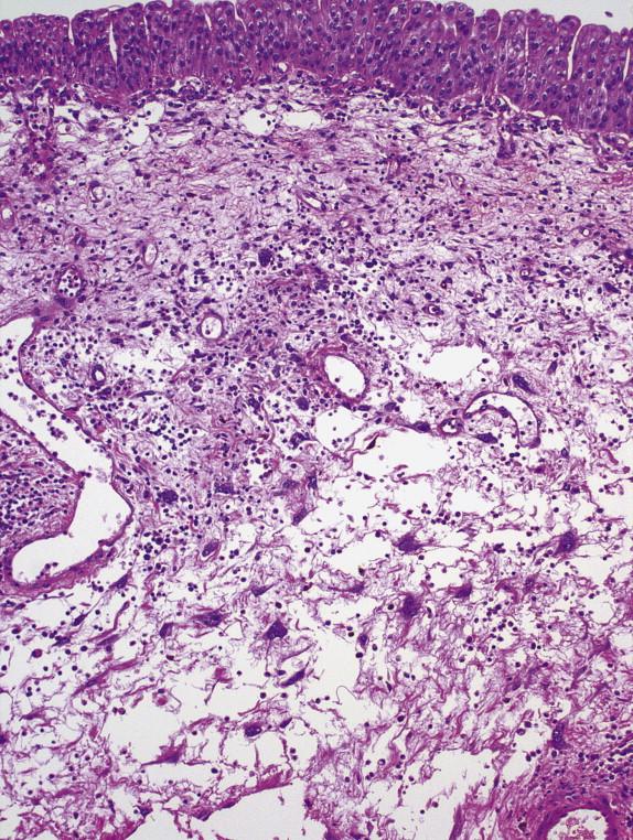 FIGURE 3-18, Giant cell cystitis: microscopic features. The lamina propria contains large stromal cells, some of which are multinucleated.
