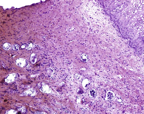 FIG. 5.4, Schistosomiasis. Viable and nonviable eggs are surrounded by fibrosis in the vaginal submucosa