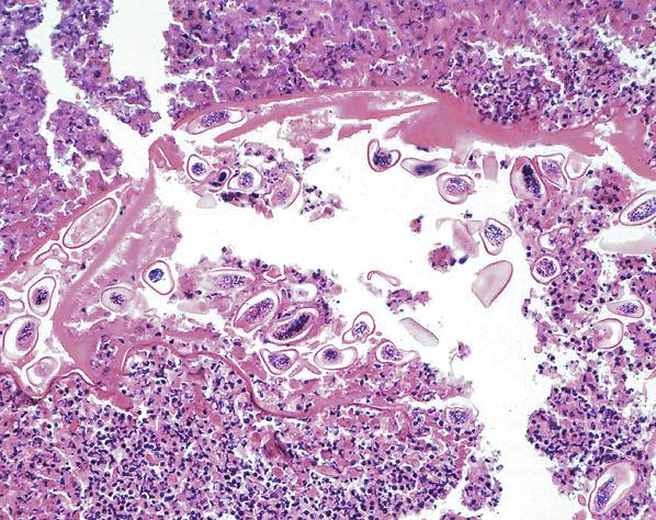 FIG. 5.5, Enterobiasis. Multiple eggs of Enterobius vermicularis are associated with necrosis and acute inflammation.