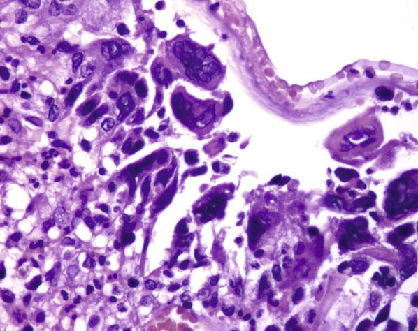 FIG. 5.6, Herpes simplex virus infection Infected squamous cells show multinucleation, nuclei with ground-glass chromatin with peripheral margination and intranuclear inclusions.