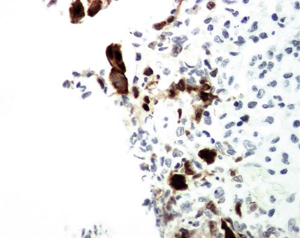 FIG. 5.7, Herpes simplex virus infection. In situ hybridization highlights the infected cells.