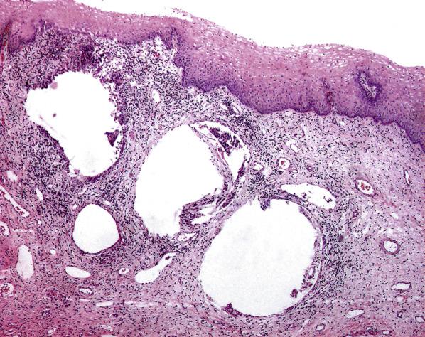 FIG. 5.8, Emphysematous vaginitis. Several irregular pseudocystic spaces (lacking an epithelial lining) are surrounded by marked chronic inflammation.