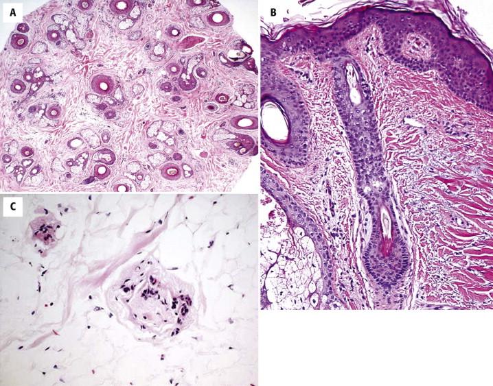 FIGURE 8-2, Androgenetic alopecia. A, There is an increase in the density of miniaturized follicles, leading to a higher number of vellus hair follicles and stelae (horizontal section). B, Vellus hair follicles (conventional vertical section). C, Follicular stelae in subcutis (horizontal section).