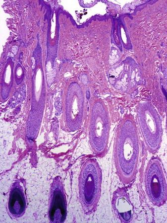 FIGURE 8-5, Acute telogen effluvium. There is a predominance of terminal hair follicles.