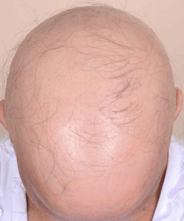 FIGURE 8-6, Anagen arrest. Anagen arrest with loss of more than 90% of scalp hair (anagen effluvium).