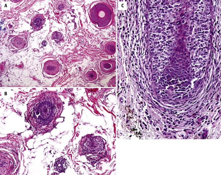 FIGURE 8-8, Alopecia areata. A, There is an increase in the proportion of telogen hair (horizontal section). B, Peribulbar lymphocytes are characteristic (horizontal section). C, The lymphocytes may not only swarm around the bulb but also infiltrate it (vertical section).