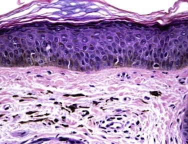 FIGURE 7-2, Melasma. Both increased melanin deposition within the basal layer of the epidermis as well as pigment incontinence in the dermis can be seen.