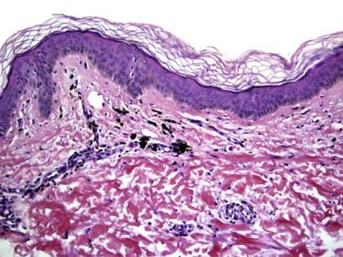 FIGURE 7-4, Erythema dyschromicum perstans (ashy dermatosis). There is pigment incontinence with numerous melanophages concentrated around vessels within the superficial dermis. A sparse perivascular inflammatory infiltrate is also present.